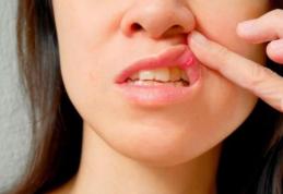 Remedii naturiste pentru ulcer bucal și afte
