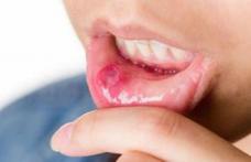 Atenție! Aftele bucale pot anunța lipsa unor vitamine, imunitate scăzută dar și boli grave