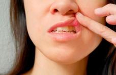 Remedii naturiste pentru ulcer bucal și afte