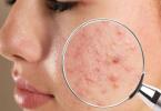 acnee-cauze-tratament