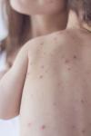 Lista județelor cele mai afectate de epidemia de rujeolă