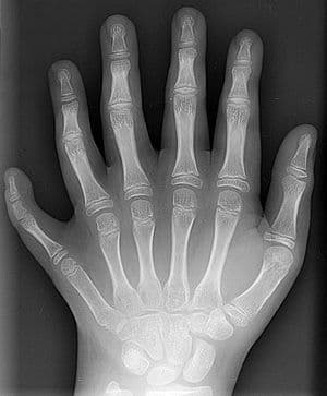 Află când radiografiile devin periculoase