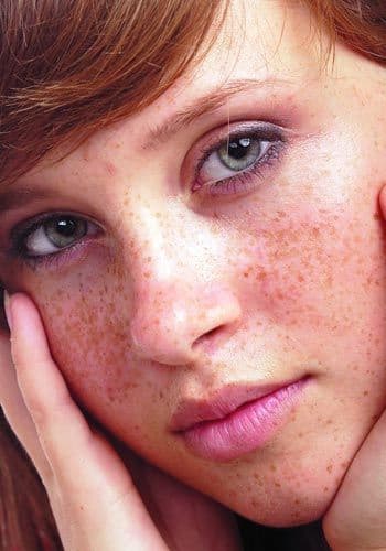Scapă de pistrui cu cele mai bune remedii naturale!