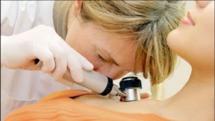 Alunițele canceroase devin periculoase la ultraviolete