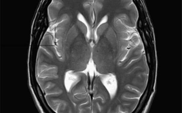 Incredibil! Vezi ce au descoperit medicii în creierul unei femei