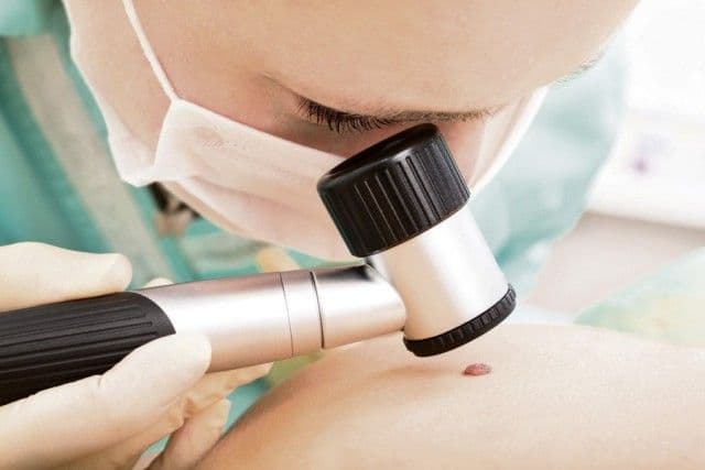Controlul pielii, o necesitate! Cum îţi dai seama dacă o aluniţă este canceroasă sau nu