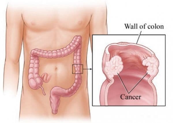 Cancerul de colon poate fi prevenit din adolescenţă cu ajutorul unui aliment