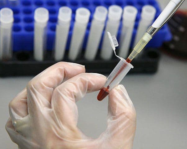 28 iulie Ziua Mondială de Luptă împotriva Hepatitei. Numărul bolnavilor cu hepatită C în creştere