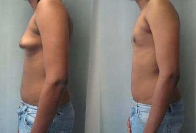 Cât de dăunător este consumul de carne de pui injectată cu hormoni