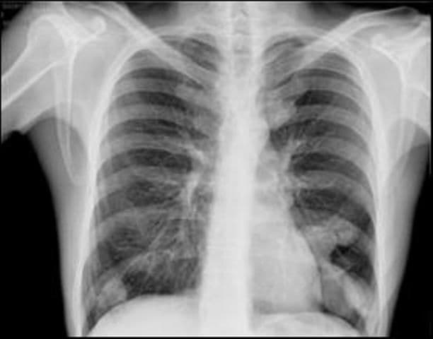 Medicii au văzut radiografia şi au încremenit. Pacienta: „L-am înghiţit de teama prietenului meu”