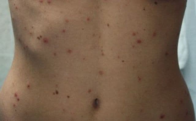 Alertă! Varicela face ravagii printre adulţi - cum previi boala şi ce complicaţii are