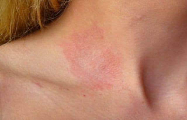 Ce afecţiuni anunţă înroşirea pielii şi mâncărimile după expunerea la soare
