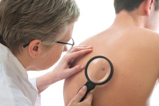 Metoda prin care poţi verifica imediat care aluniţe reprezintă un risc de cancer de piele