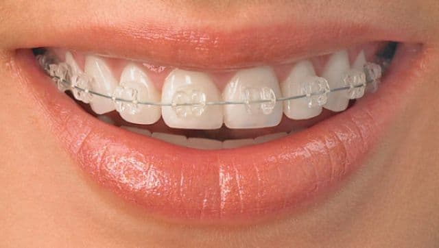 Mituri despre aparatele dentare. Cât de mult te ajută?