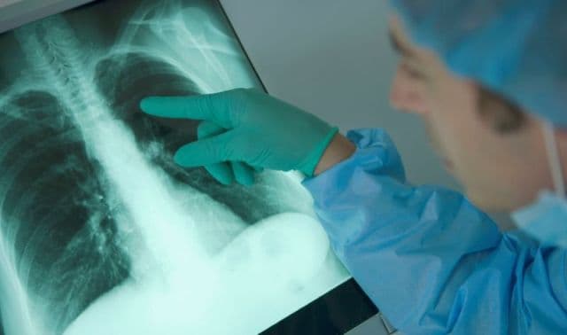 Un semn banal arată cancerul de plămâni încă din stadiu incipient