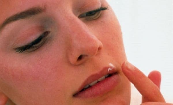 Așa scapi de herpes, cu ce ai în casă