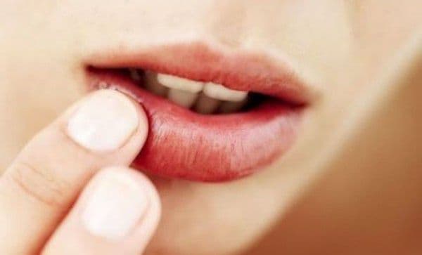 Cum să scapi de herpes simplu şi rapid