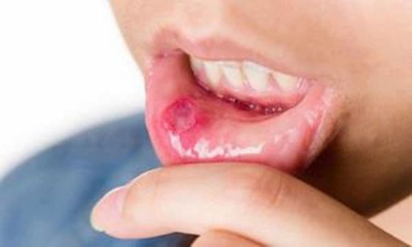 Atenție! Aftele bucale pot anunța lipsa unor vitamine, imunitate scăzută dar și boli grave