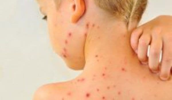 Epidemie de rujeolă în 32 de județe: 7 decese, 1.700 de cazuri confirmate. Ce măsuri vor lua autoritățile?