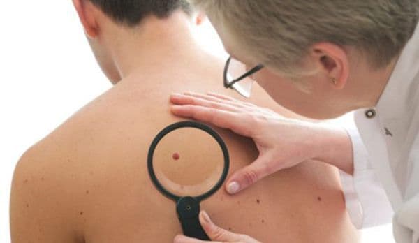 Medicii trag un semnal de alarmă: Ce sunt, de fapt, aluniţele roşii care apar pe corp