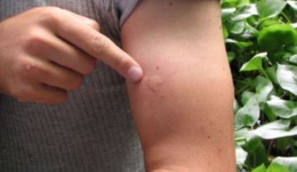 Cum știi dacă ai boala Lyme după ce te mușcă o căpușă