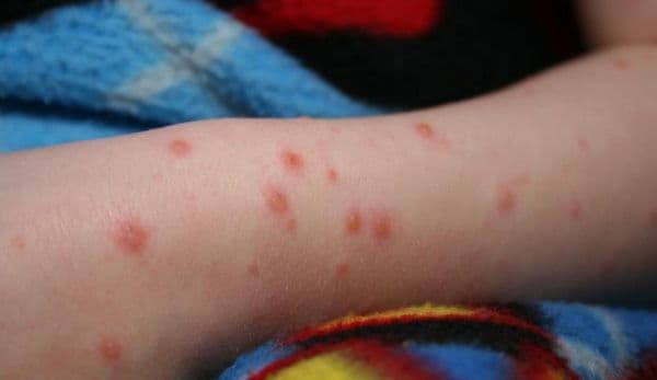 Trei copii din Dorohoi au ajuns la spital cu rujeolă după ce mama lor a refuzat să îi vaccineze