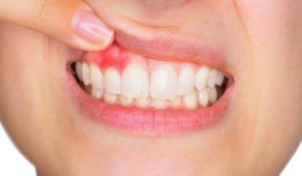 Boala gingiilor. Simptome, cauze și tratamente
