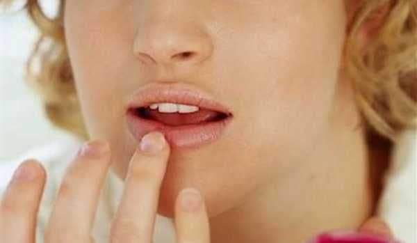 Opt trucuri pentru a scăpa rapid de herpes