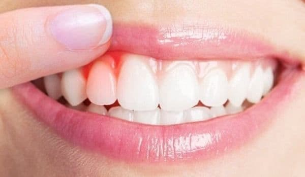 Remedii naturiste pentru sângerările gingivale