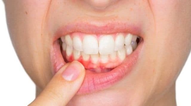 Tratamente din plante pentru abces dentar
