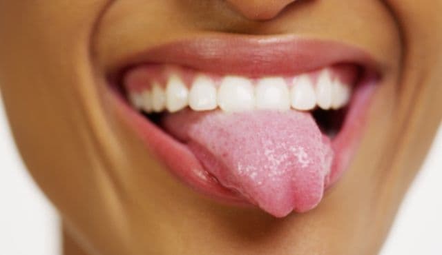 Cauze posibile pentru culoarea albă a limbii
