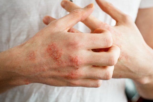 O boală de piele extrem de dureroasă este agravată de stres