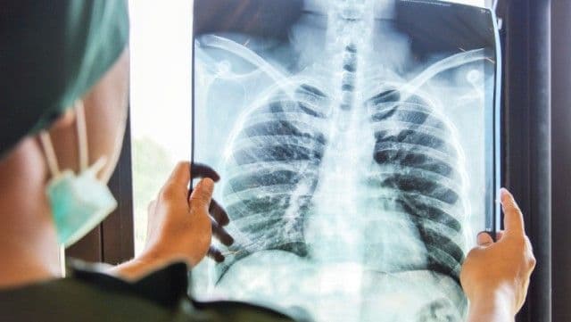 Un medic pneumolog explică problemele respiratorii ale unui pacient vindecat de COVID-19