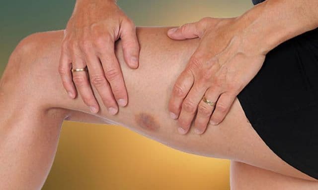Semnele care anunță leucemia: care sunt persoanele cu risc
