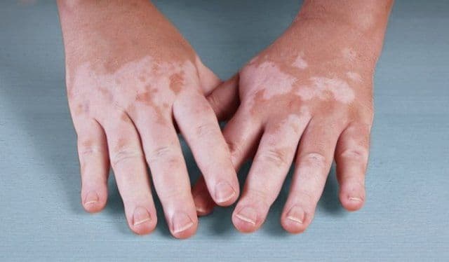 Cum apare și cum trebuie să ne îngrijim atunci când suferim de Vitiligo