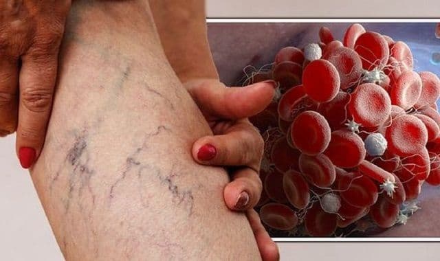 Simptome care vă informează despre prezenta un cheag de sânge în corp