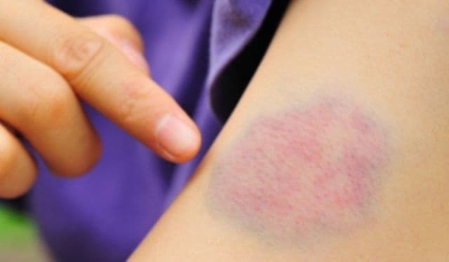 Semnele care anunță leucemia: care sunt persoanele cu risc