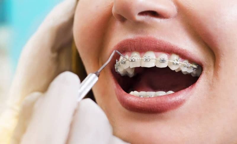 Vârsta maximă până la care sunt recomandate aparatele dentare