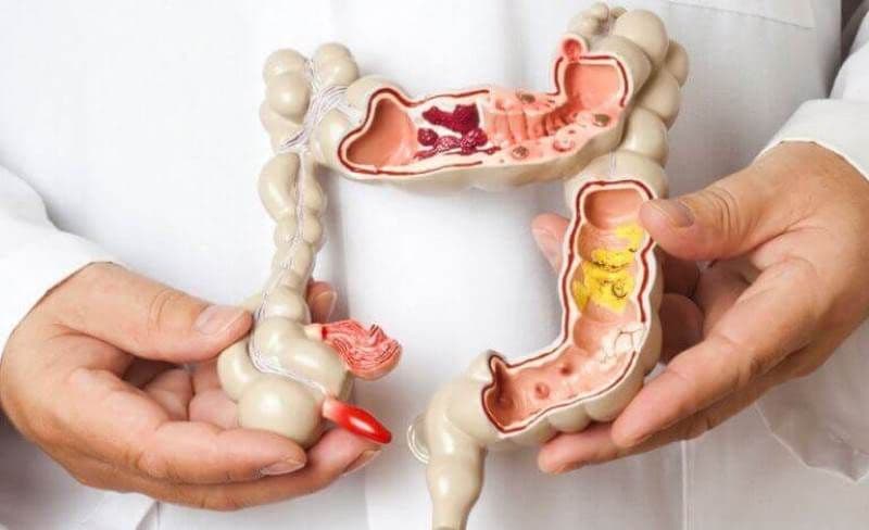 Sindromul de colon iritabil: cum vă liniștiți abdomenul