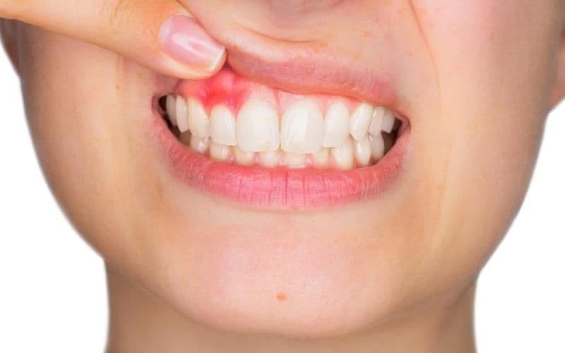 Trei rețete naturale de oprire a sângerărilor gingivale
