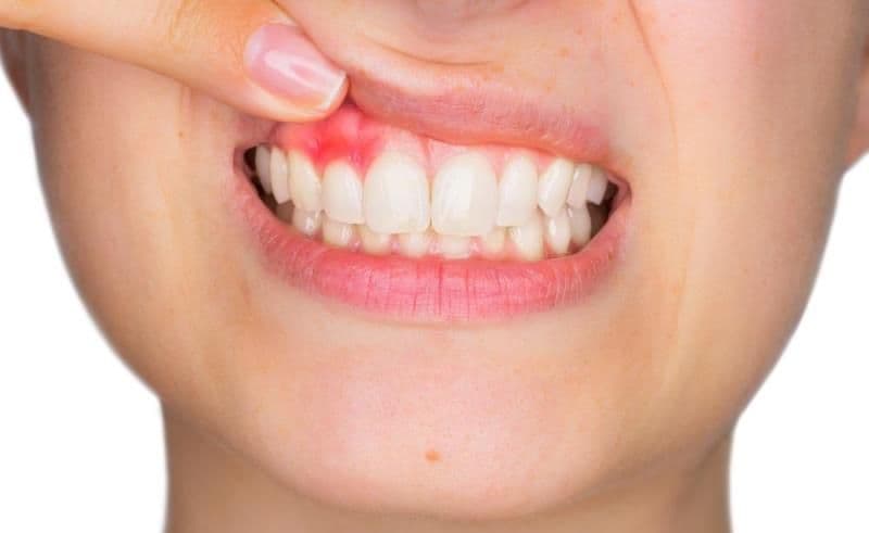 Rețete naturale de oprire a sângerărilor gingivale