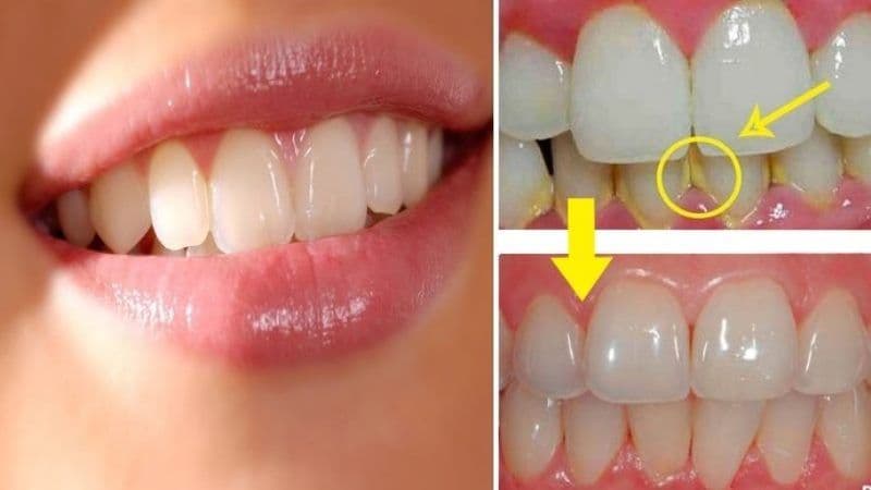 Sfaturi pentru a elimina tartrul dentar în mod natural