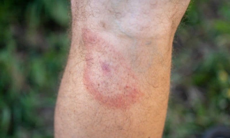 Câteva semne de avertizare că aveți boala Lyme transmisă de căpușe