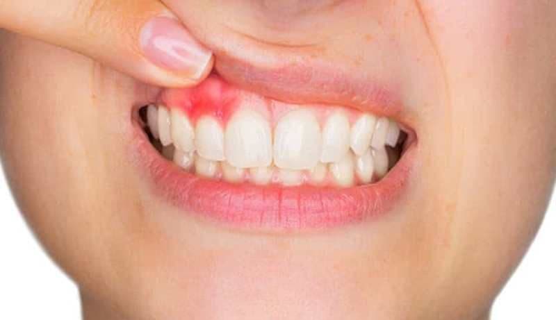 Retețe naturale de oprire a sângerărilor gingivale