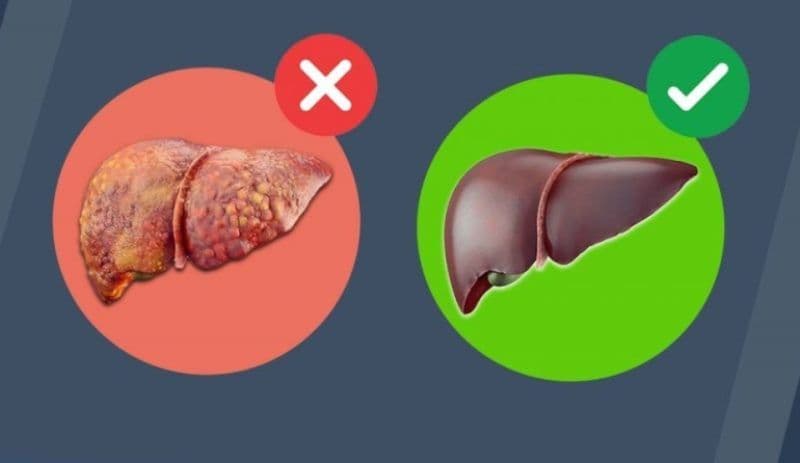 Cum poți detoxifia ficatul gras folosind un singur ingredient? 
