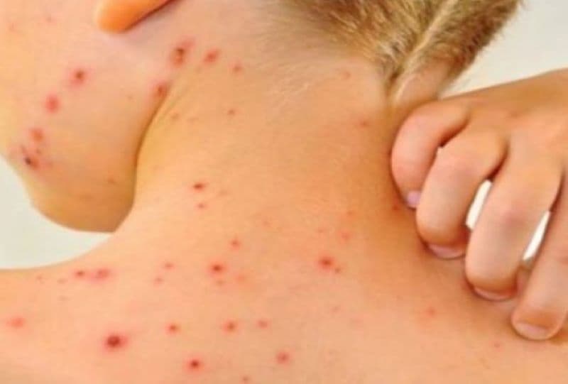 Ministerul Sănătății a declarat epidemie de rujeolă la nivel național. Creștere îngrijorătoare a cazurilor de infectare