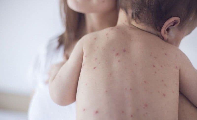Lista județelor cele mai afectate de epidemia de rujeolă