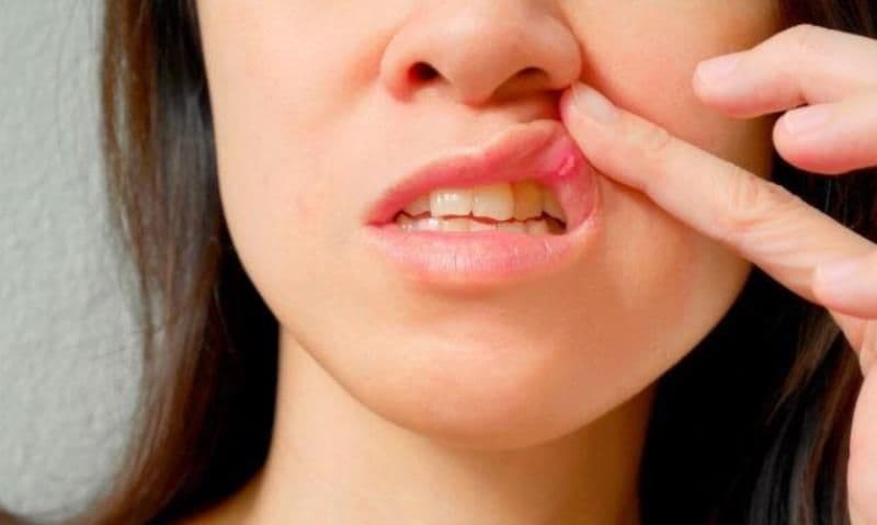 Remedii naturiste pentru ulcer bucal și afte