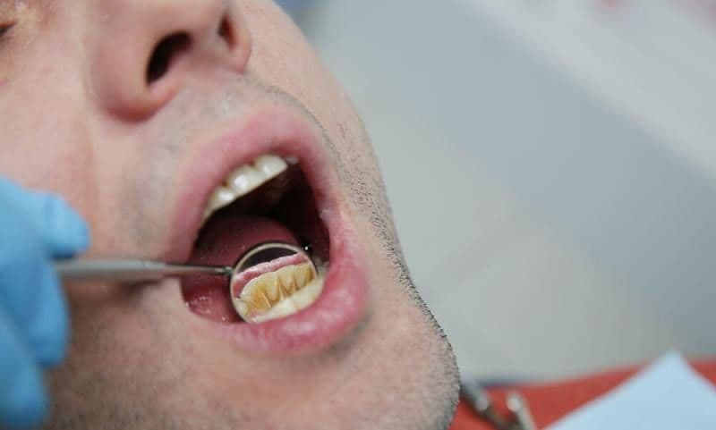 Sfaturi pentru a elimina tartrul dentar în mod natural