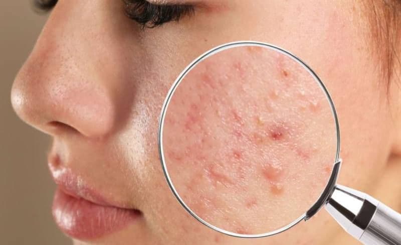 Ceaiuri recomandate pentru combaterea acneei